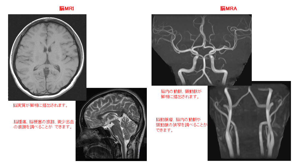 脳（頭部MRI・頭部MRA・頚部MRA）