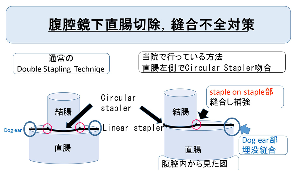 腹腔鏡下直腸切除、縫合不全対策