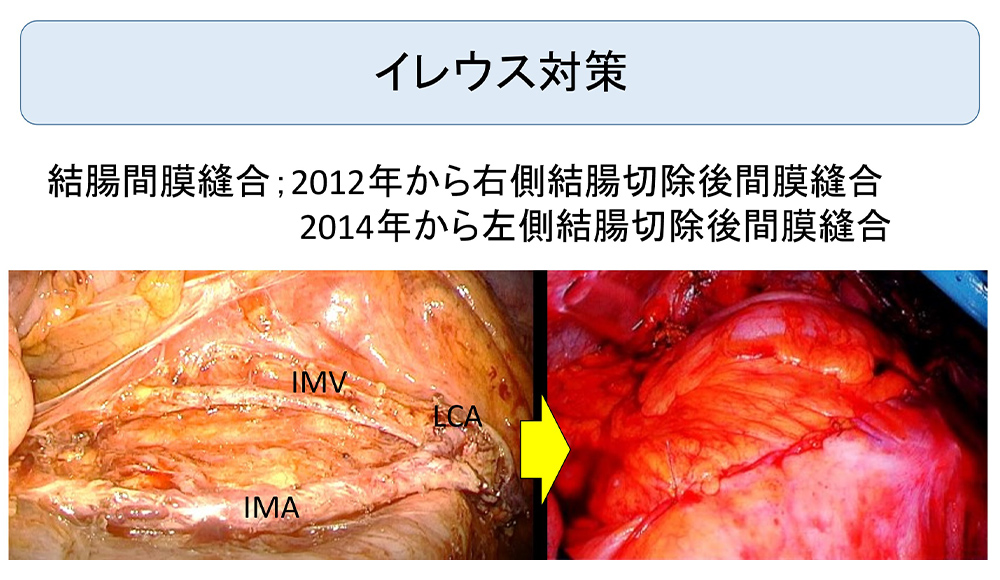 イレウス対策