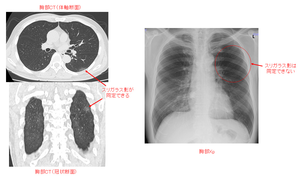 胸部CT