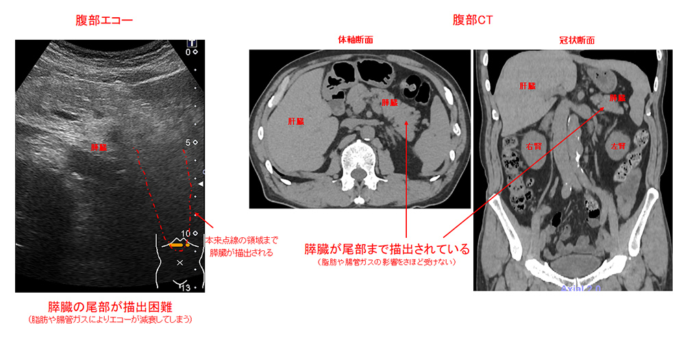 腹部CT 